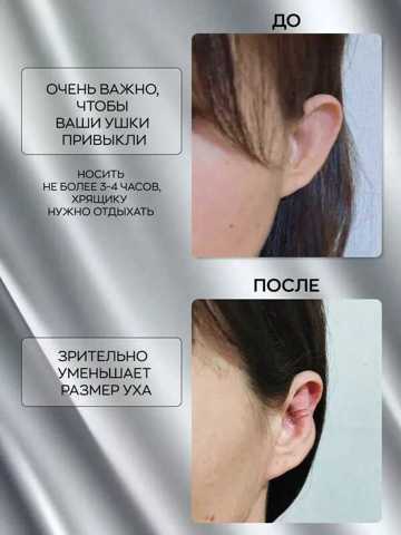 Каффы КорреКторы Ушей От Лопоухости Для Взрослых