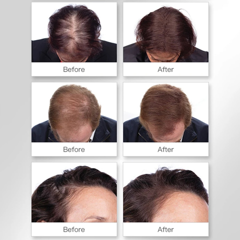 Kirkland Signature 5% Миноксидил для роста волос у мужчин, 6 упаковок